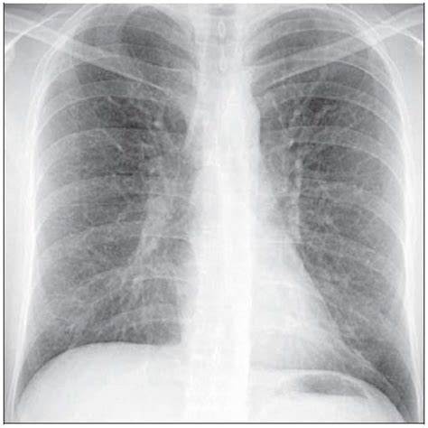 x ray for asthma